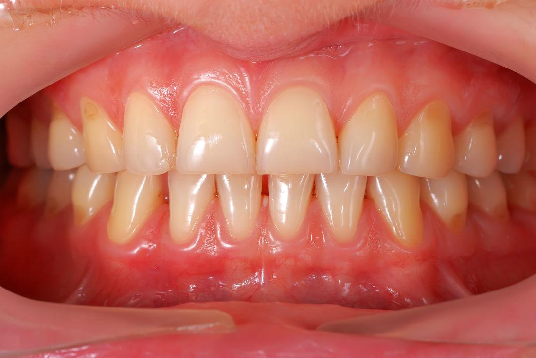 The Far-Reaching Impact of Gum Health